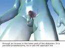 Prostate Cancer - Radical Prostatectomy