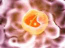 Prostate Cancer Animation