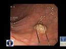 Colon Cancer