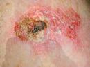 How Does Skin Cancer Work?