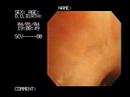 Lung Cancer Bronchoscopy