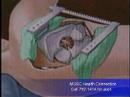 VATS Surgery for Lung Cancer