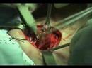 Thyroid Surgery