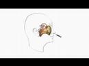 Advanced Brain Tumor Surgery at Wockhard