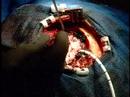Brain Tumor Surgery/GliaSite Radiation