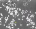 Human granulocytes kill cervical cancer